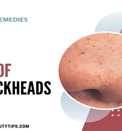 best way to remove blackheads at home; blackhead removal; home remedies to get rid of blackheads; how do you get rid of blackheads; how to get rid of blackheads; how to get rid of blackheads at home