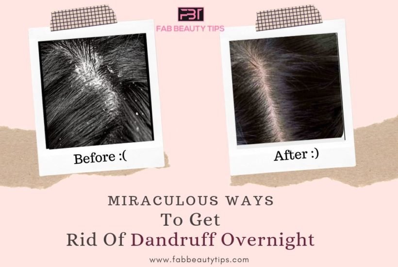 overnight remedy for dandruff, overnight home remedies for dandruff, rid of dandruff overnight, treat dandruff overnight, get rid of dandruff overnight