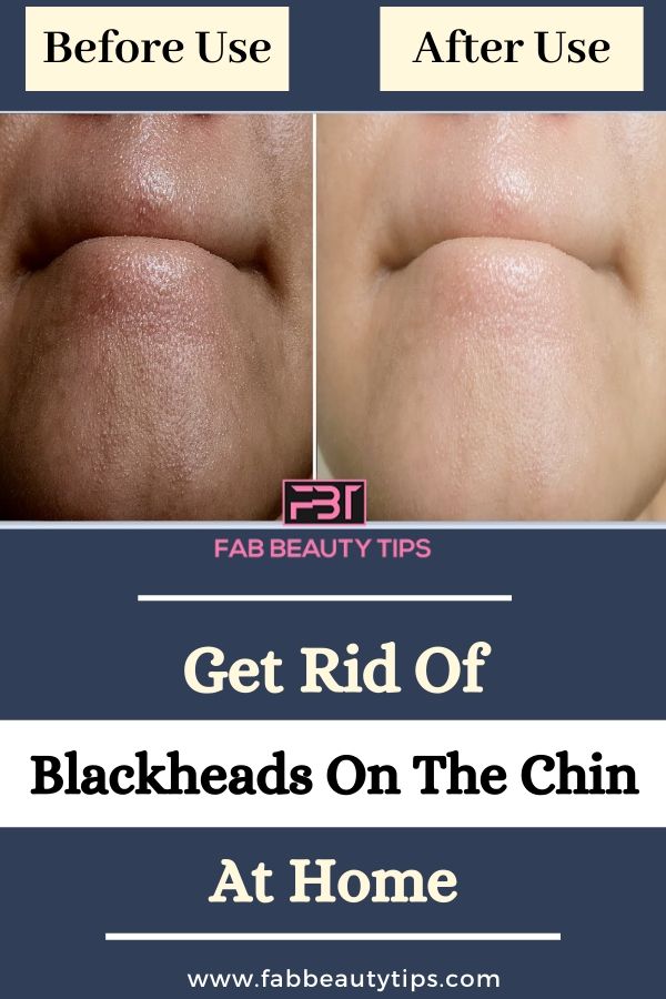 How To Remove Blackheads On Chin, how to get rid of blackheads on the chin, how to get rid of blackheads on chin