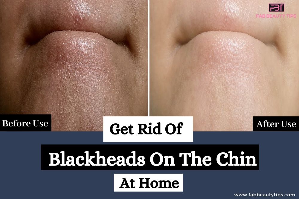 How To Remove Blackheads On Chin, how to get rid of blackheads on the chin, how to get rid of blackheads on chin