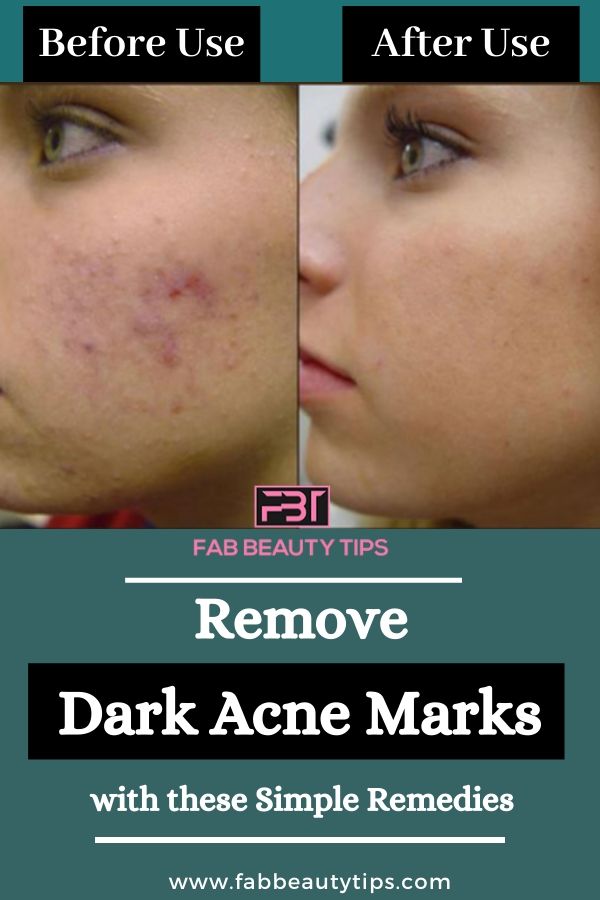 Completely Remove Dark Acne Marks with these Simple Remedies