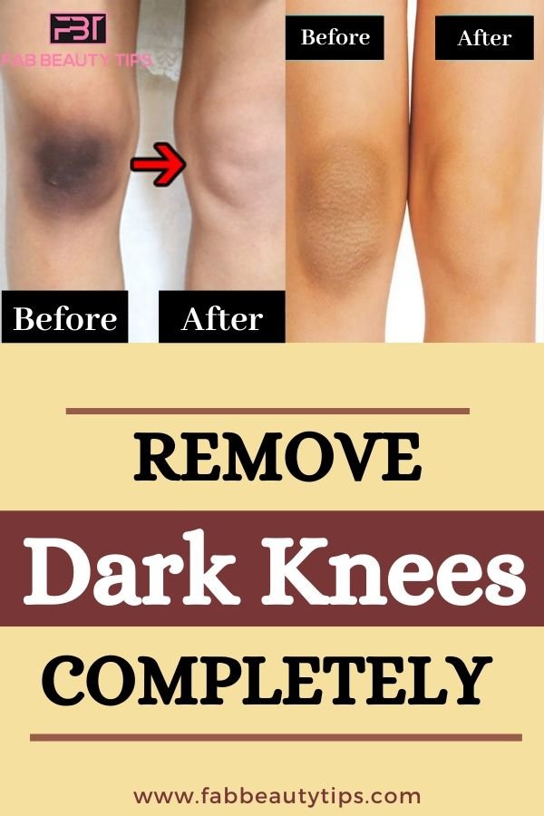 Try these amazing Home Remedies for Dark Knees! Fab Beauty Tips