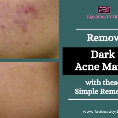 Completely Remove Dark Acne Marks with these Simple Remedies