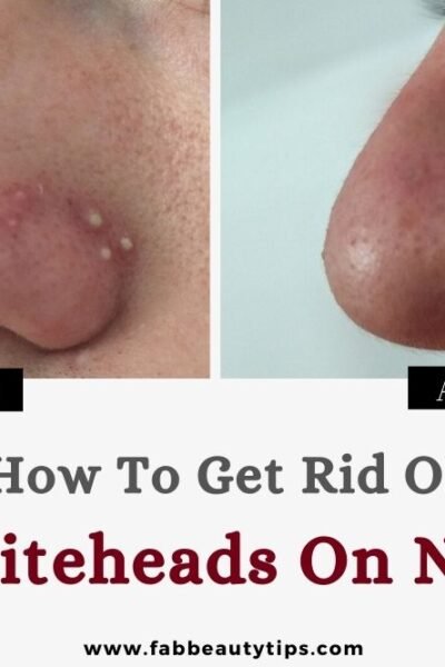 how to get rid of whiteheads on nose, how to get rid of whiteheads on nose naturally,how to get rid of whiteheads on the nose, how to get rid of whiteheads from nose
