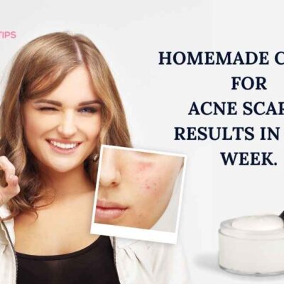 Homemade Cream for Acne Scars. Results in one week.