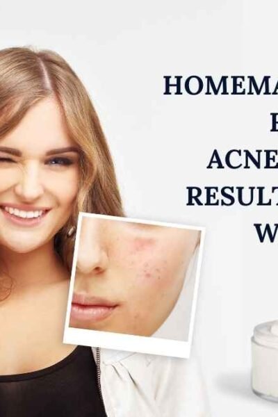 Homemade Cream for Acne Scars, Cream for Acne Scars, Acne Scars cream